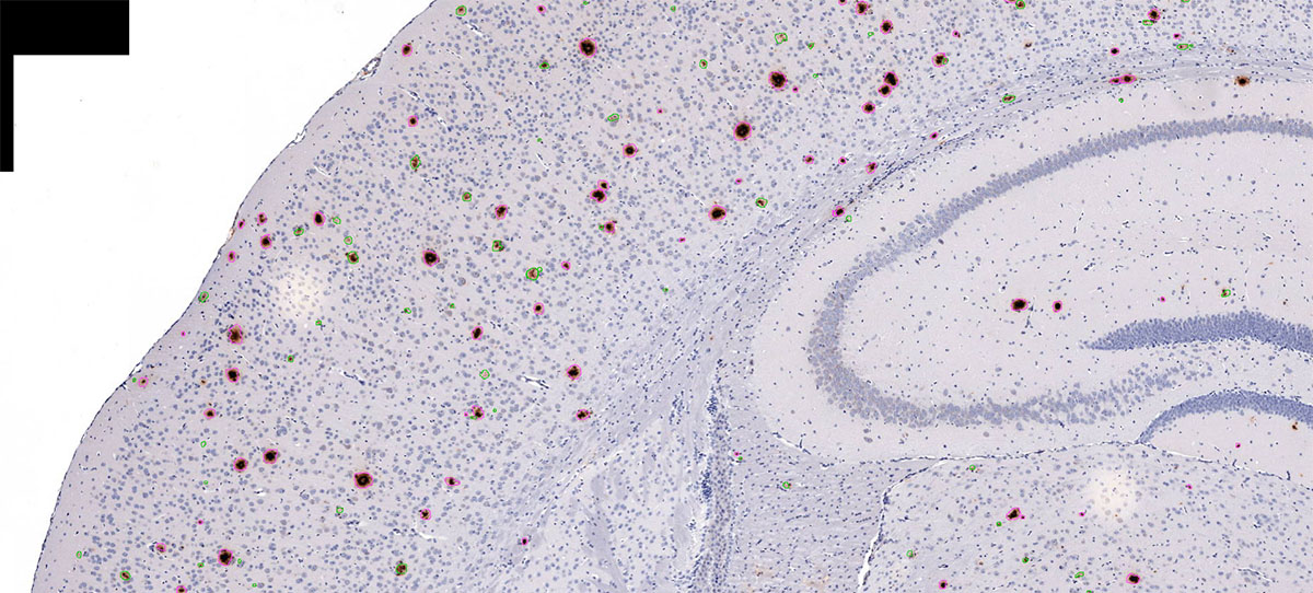 Neuropathology AI Beta Amyloid Dense/Diffuse Plaque Detection